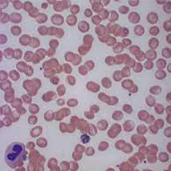 Malarial Parasite (MP) Smear